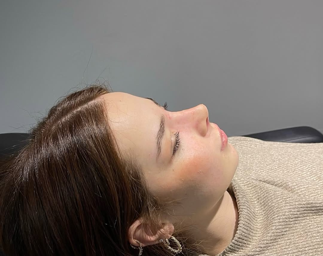 Post 3 by Dr. Hakan KARA- Rhinoplasty on Instagram (carousel)