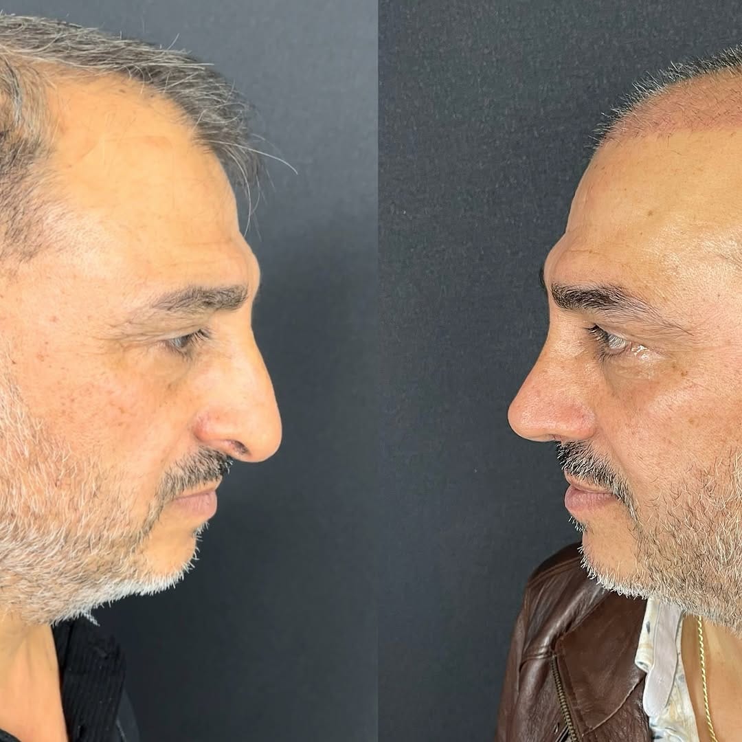 Post 2 by Dr. Hakan KARA- Rhinoplasty on Instagram (image)