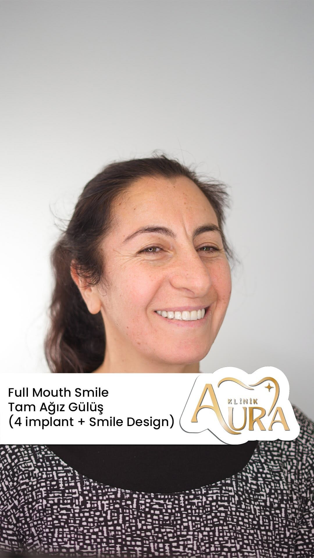Post 5 by Turkey Dentist Cagdas Guner - Çağdaş Diş Hekimi on Instagram (video)