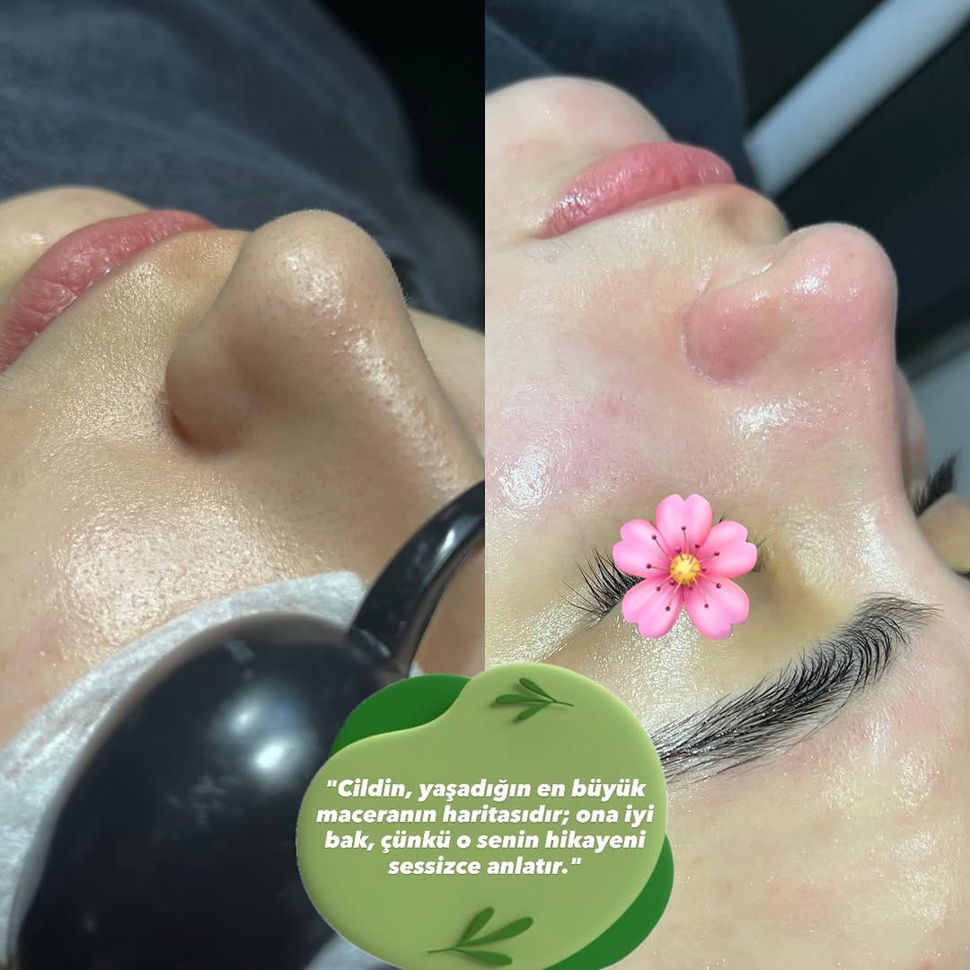 Post 10 by 𝗩İ𝗣 𝗛İ𝗭𝗠𝗘𝗧⚜️𝗟𝗔𝗭𝗘𝗥 𝗘𝗣İ𝗟𝗔𝗦𝗬𝗢𝗡 𝗠𝗘𝗥𝗞𝗘𝗭İ🪽PROTEZ TIRNAK&NAİL on Instagram (image)