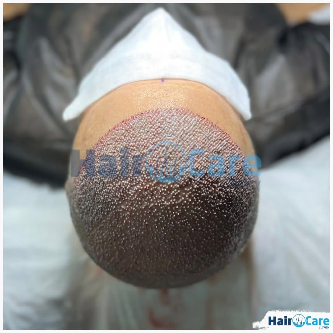 Post 10 by Hair Care Turkey on Instagram (image)