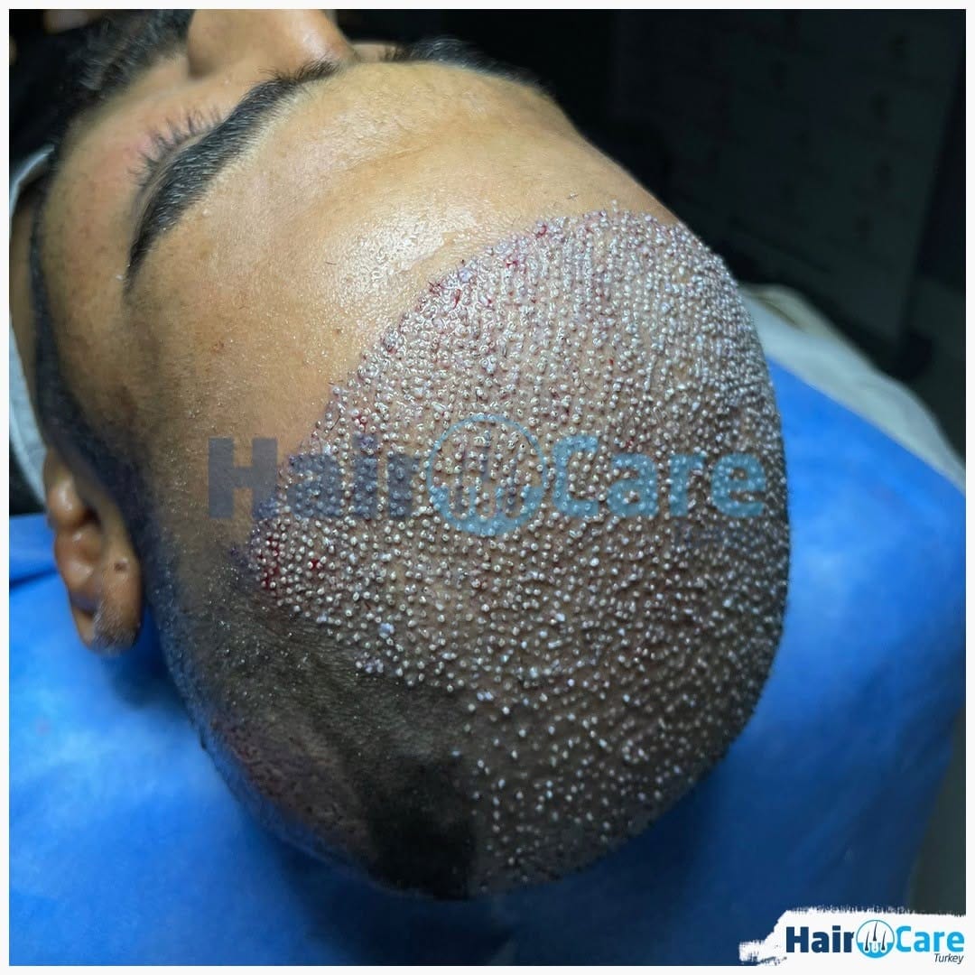 Post 4 by Hair Care Turkey on Instagram (image)