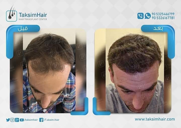 Post 3 by TaksimHair on Instagram (image)