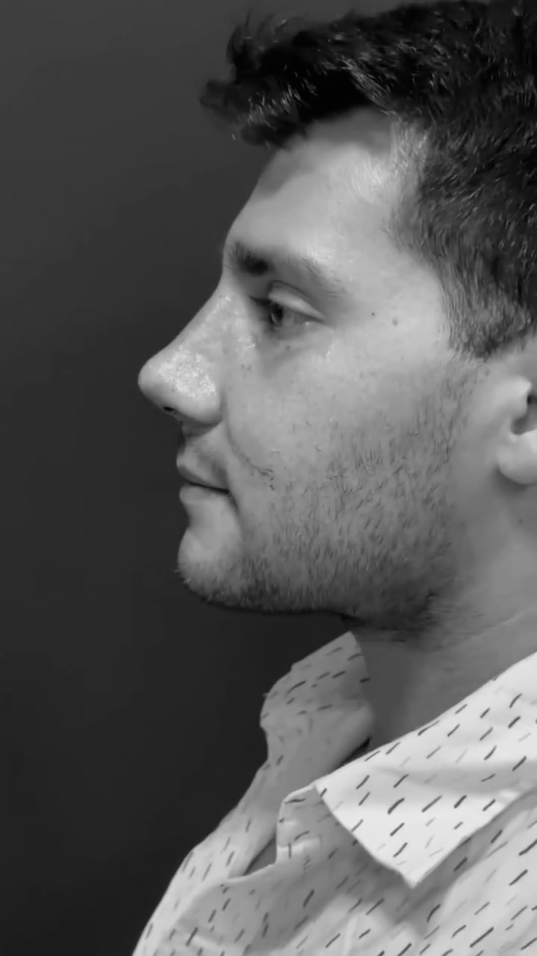 Post 5 by SKØNHEDSREJSEN PLASTIKKIRURGI 🇩🇰 on Instagram (video)
