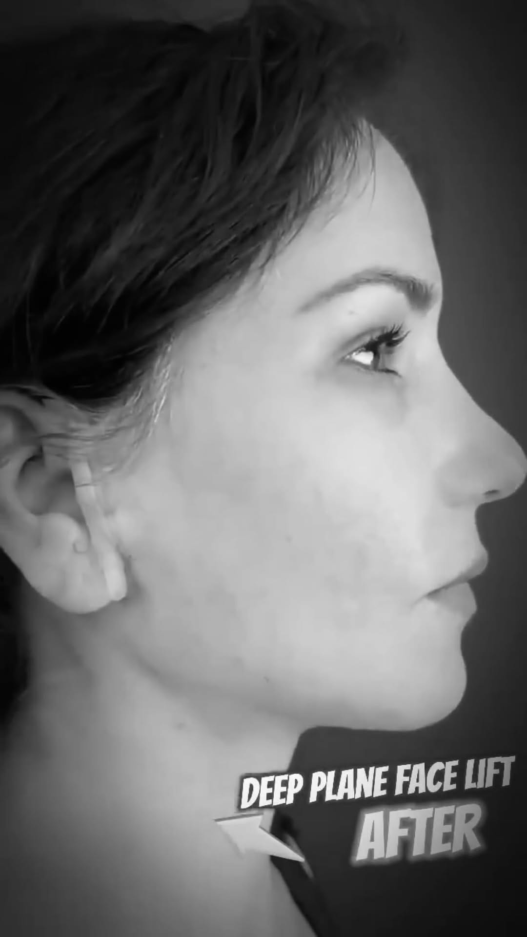 Post 7 by SKØNHEDSREJSEN PLASTIKKIRURGI 🇩🇰 on Instagram (video)