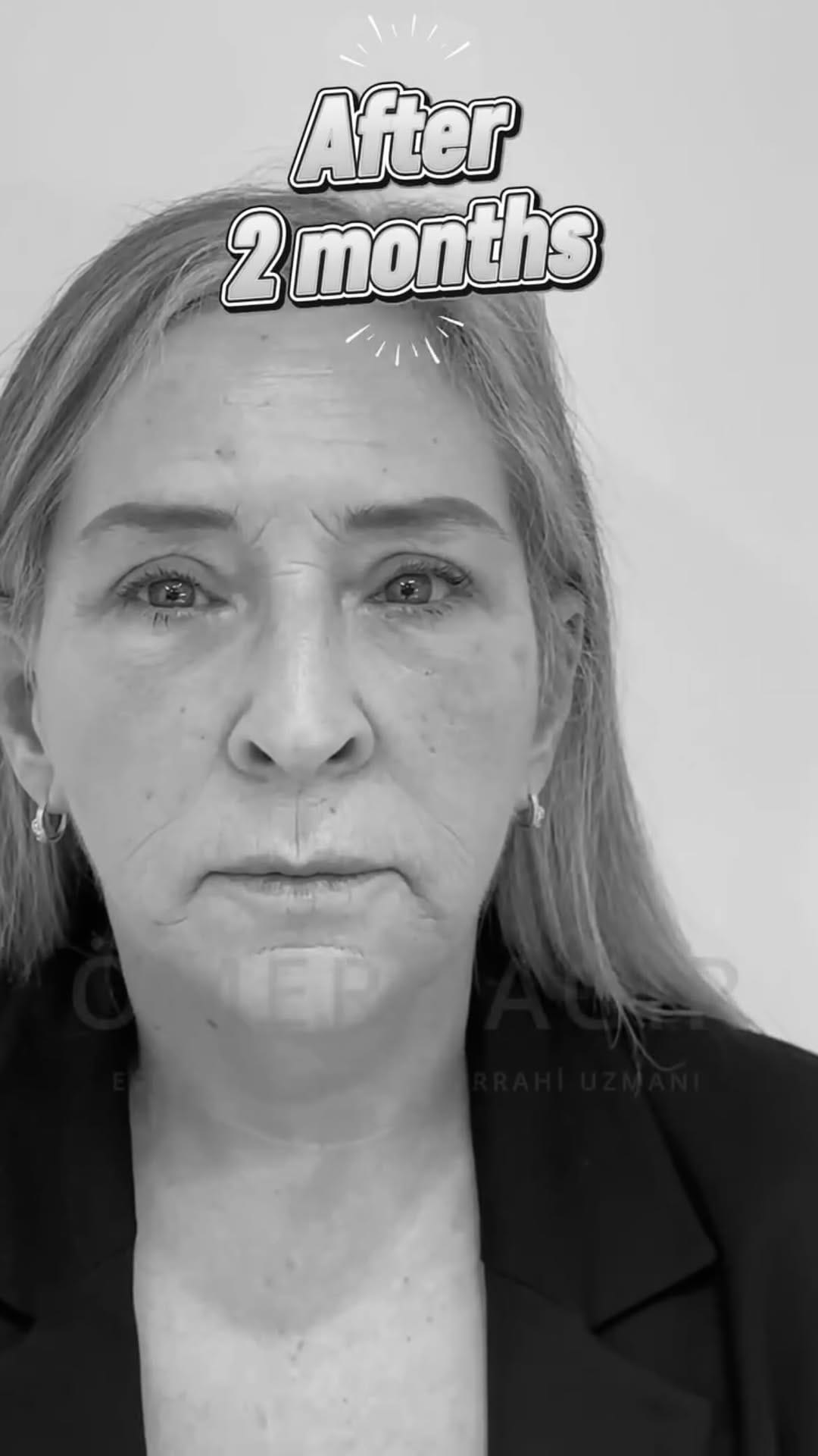 Post 4 by SKØNHEDSREJSEN PLASTIKKIRURGI 🇩🇰 on Instagram (video)