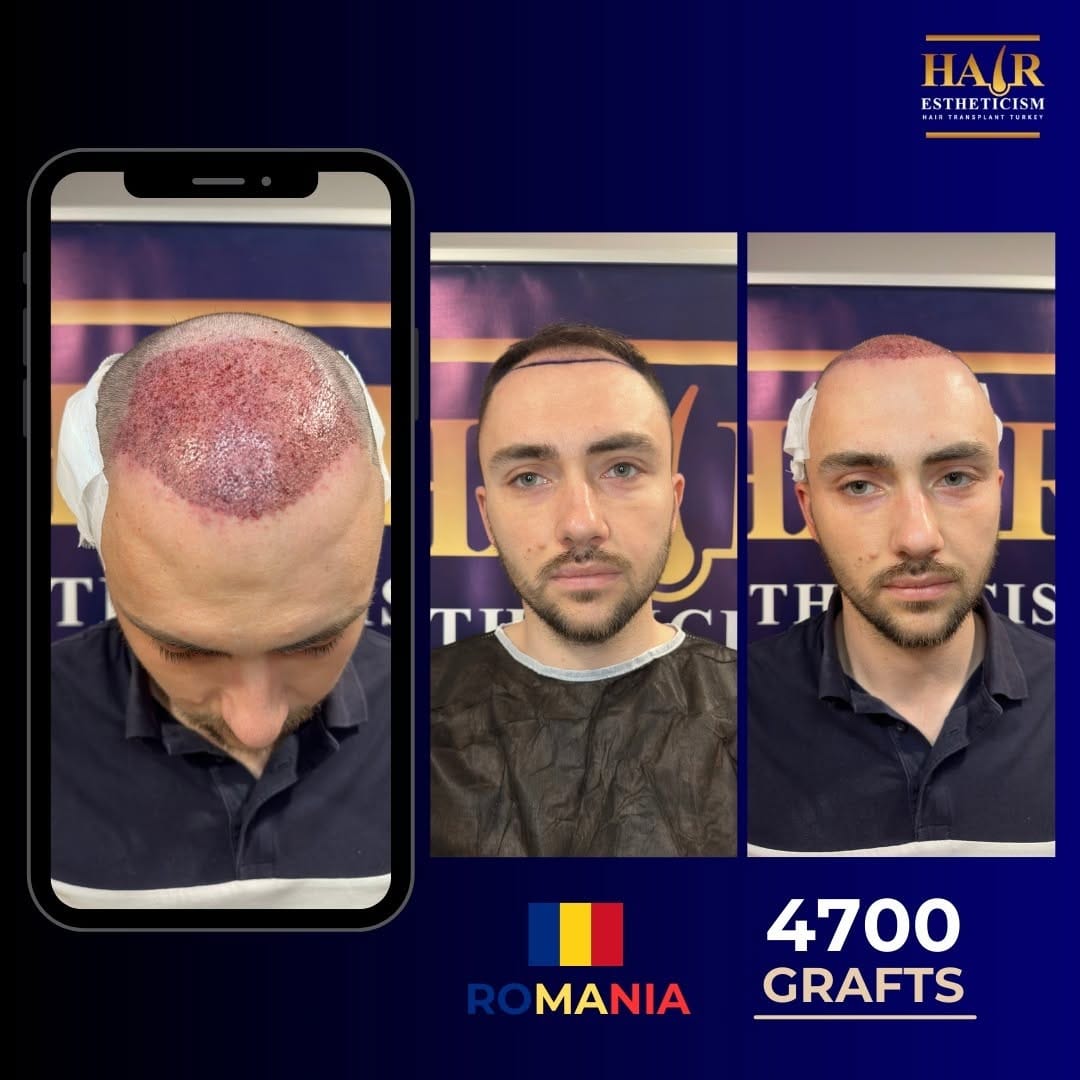 Post 6 by Hair Estheticism Hair Transplant on Instagram (carousel)