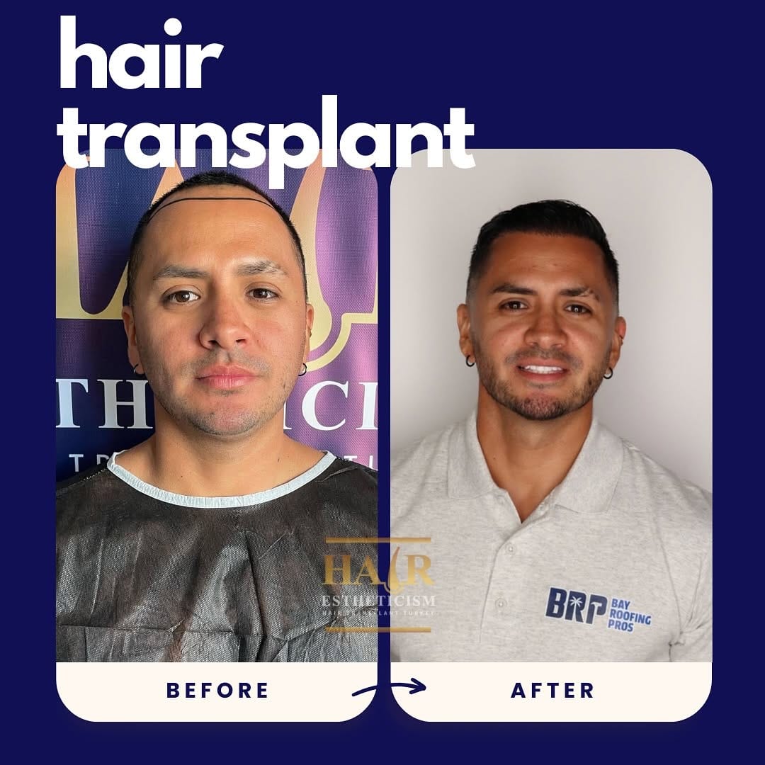 Post 1 by Hair Estheticism Hair Transplant on Instagram (carousel)