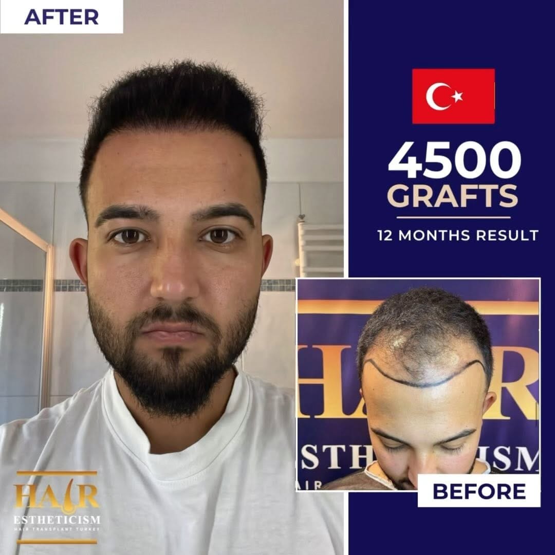 Post 2 by Hair Estheticism Hair Transplant on Instagram (video)