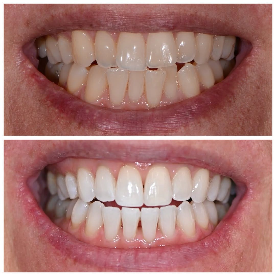 Post 1 by Olga Papasotiriou Dr.med.dent., MSD, FICD on Instagram (carousel)