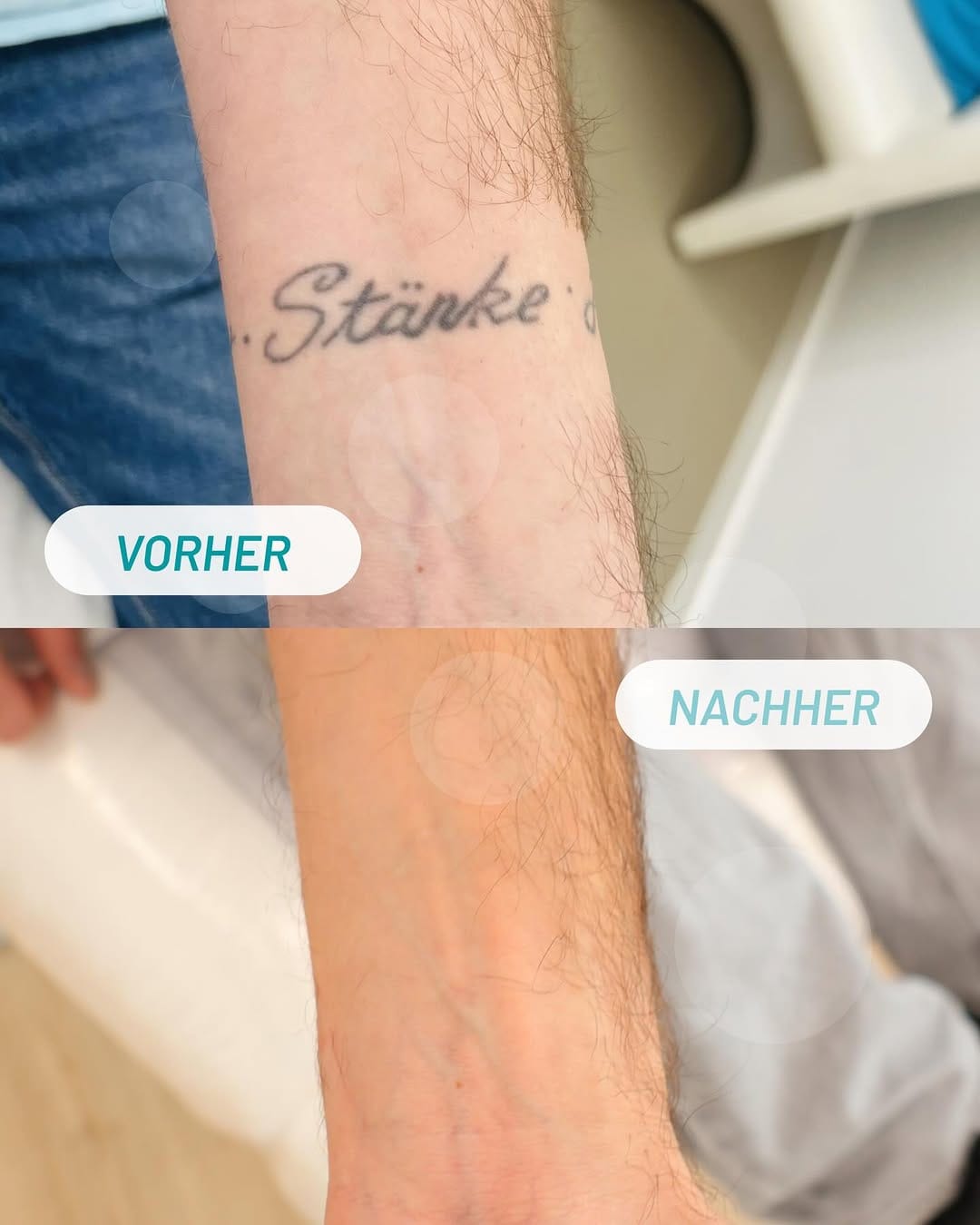 Post 7 by ENDLICH OHNE TATTOOENTFERNUNG on Instagram (image)
