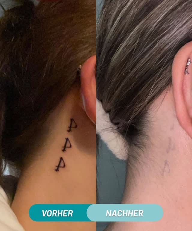 Post 6 by ENDLICH OHNE TATTOOENTFERNUNG on Instagram (video)