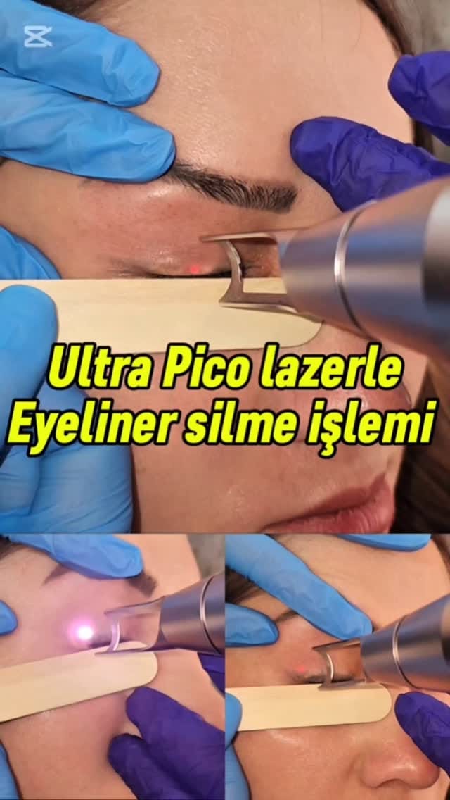 Post 8 by izmir dövme silme merkezi on Instagram (video)