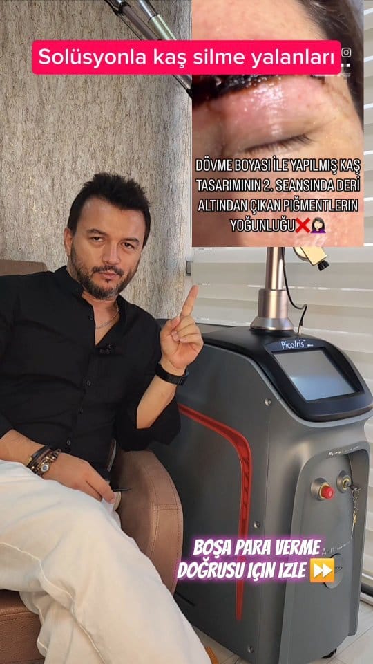 Post 10 by izmir dövme silme merkezi on Instagram (video)