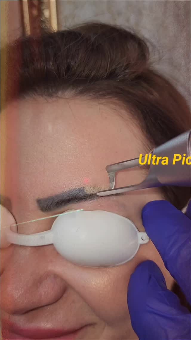 Post 2 by izmir dövme silme merkezi on Instagram (video)