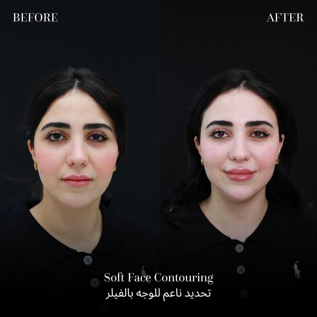 Post 4 by مركز لوس أنجلوس للتجميل الطبي on Instagram (carousel)