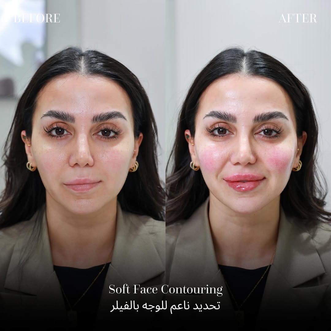 Post 7 by مركز لوس أنجلوس للتجميل الطبي on Instagram (carousel)