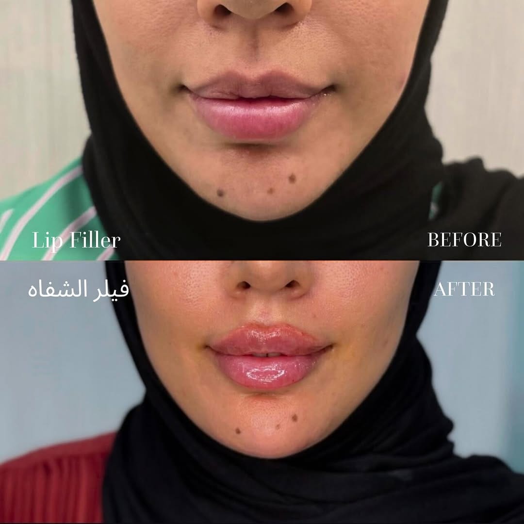 Post 2 by مركز لوس أنجلوس للتجميل الطبي on Instagram (carousel)