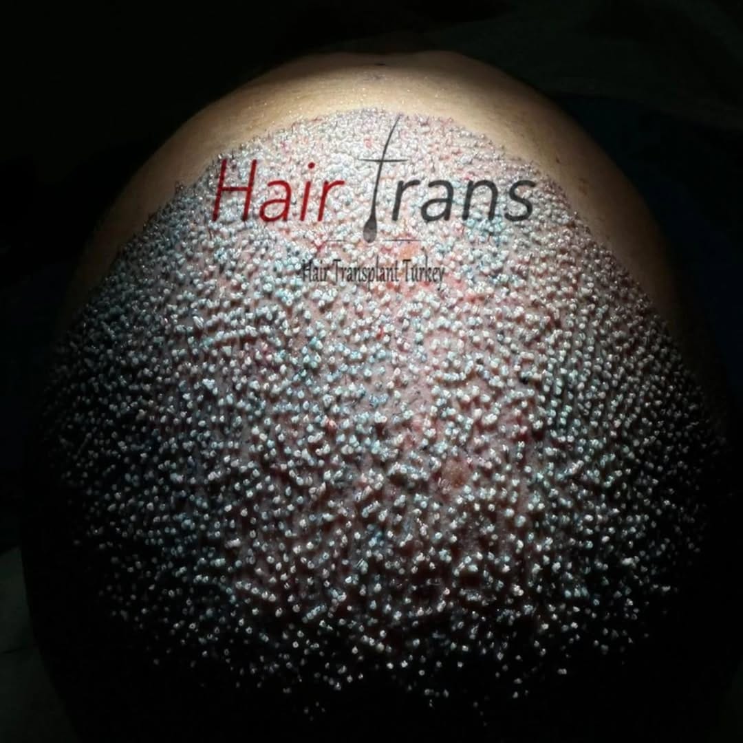Post 7 by Samsun Saç Ekimi Hair Trans on Instagram (image)