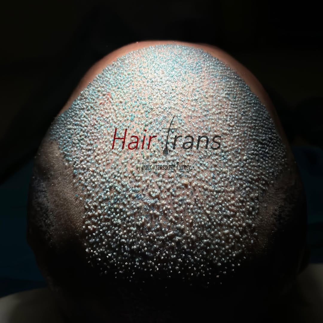 Post 8 by Samsun Saç Ekimi Hair Trans on Instagram (image)