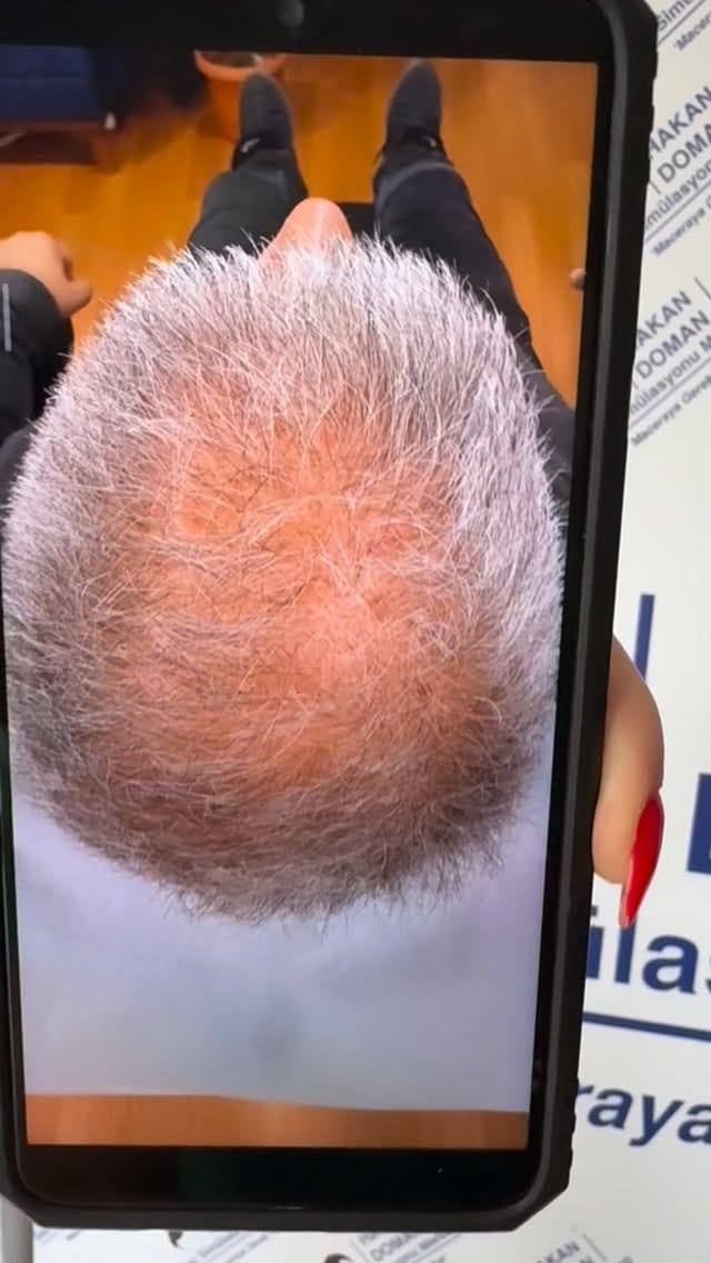 Post 1 by Saç simülasyonu uzmanı  SMP on Instagram (video)