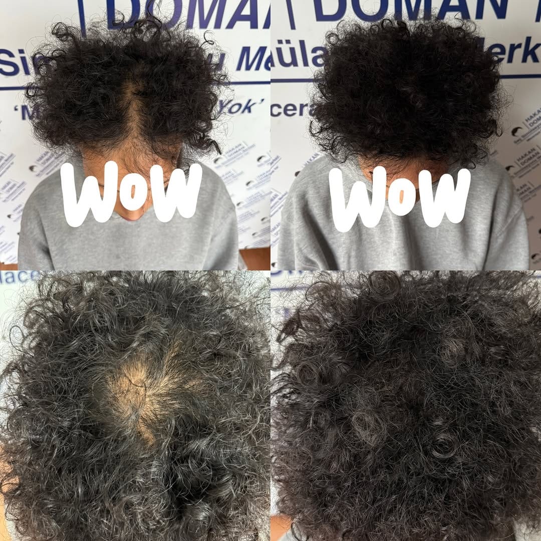 Post 3 by Saç simülasyonu uzmanı  SMP on Instagram (image)