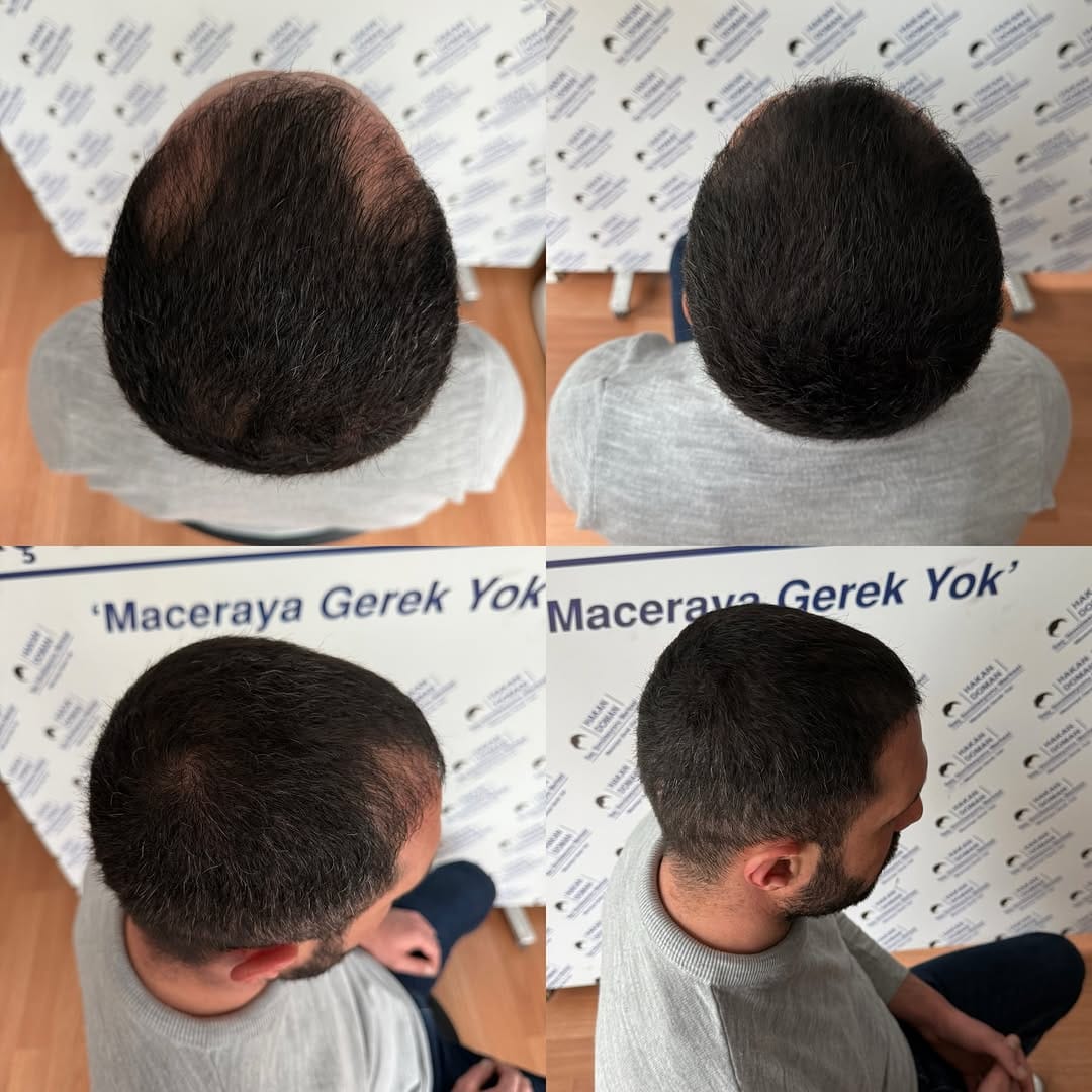 Post 2 by Saç simülasyonu uzmanı  SMP on Instagram (image)