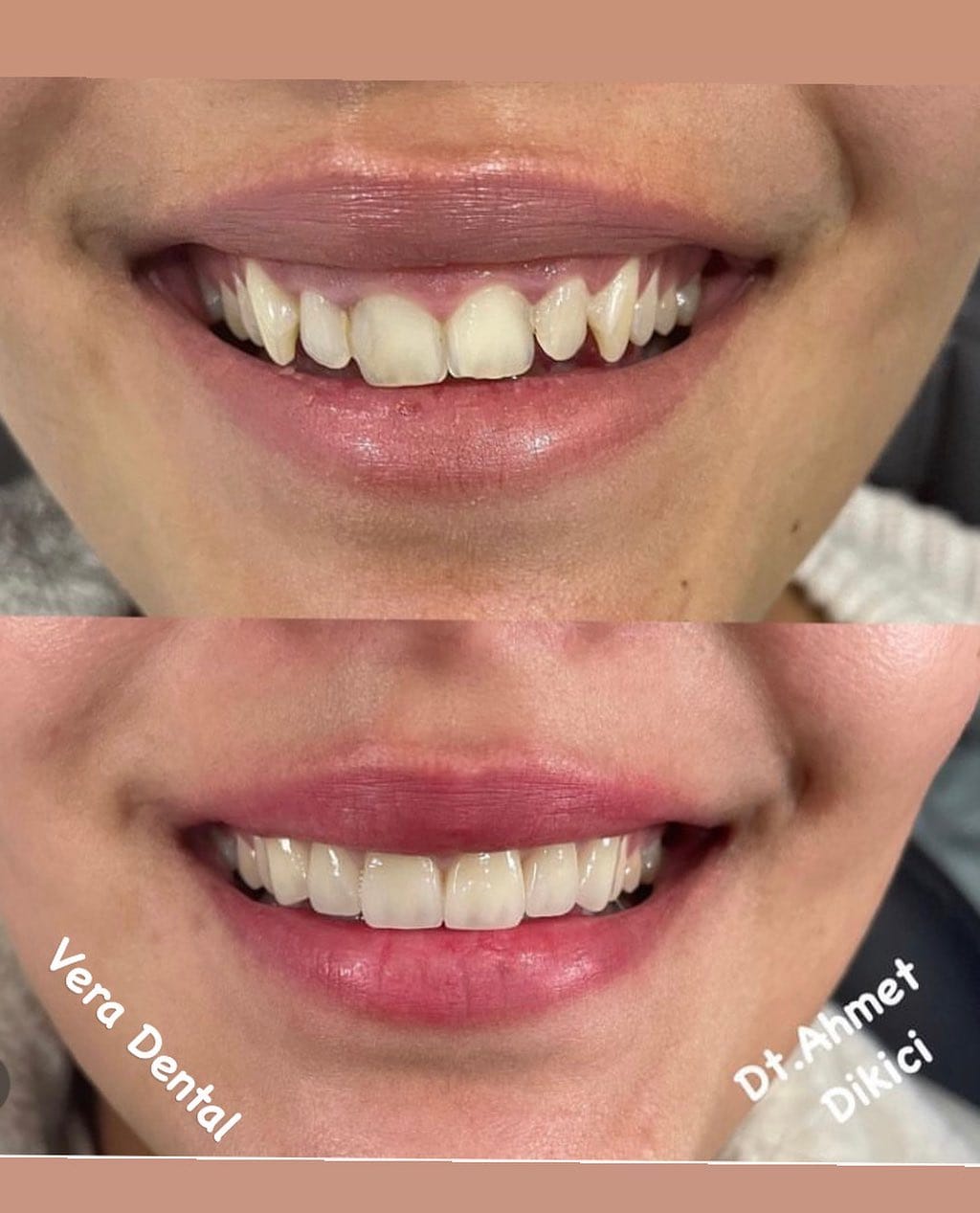 Post 4 by VERA DİŞ PROTEZ LABORATUVARI on Instagram (image)