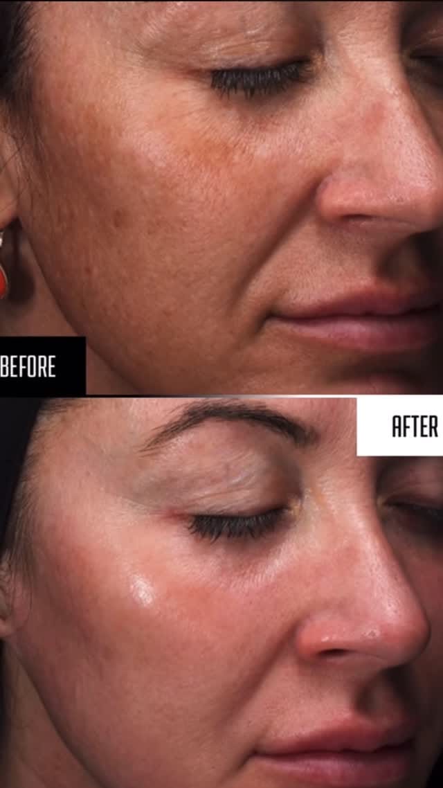 Post 7 by UZM.COSMETOLOGYST BÜŞRA EROĞLU on Instagram (video)