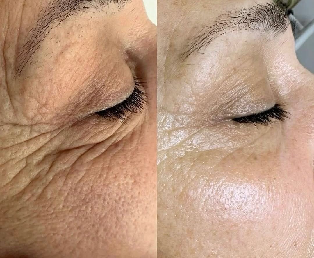 Post 1 by UZM.COSMETOLOGYST BÜŞRA EROĞLU on Instagram (image)