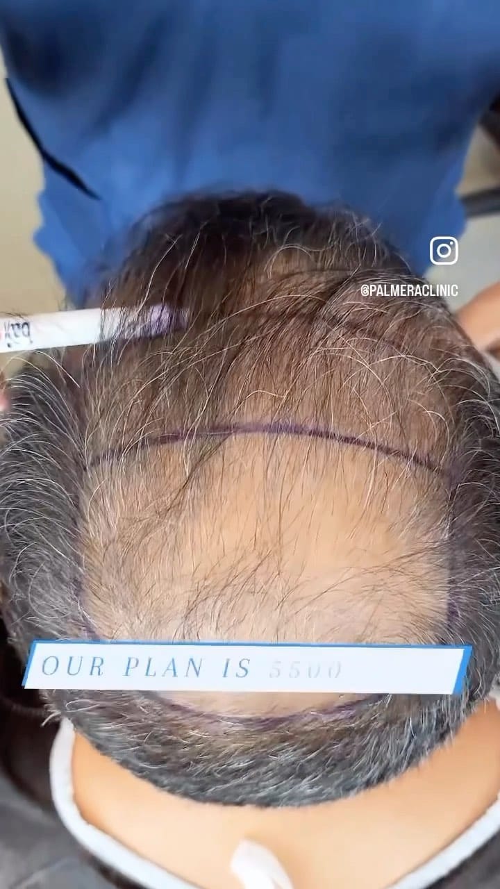 Post 2 by palmera clinic on Instagram (video)