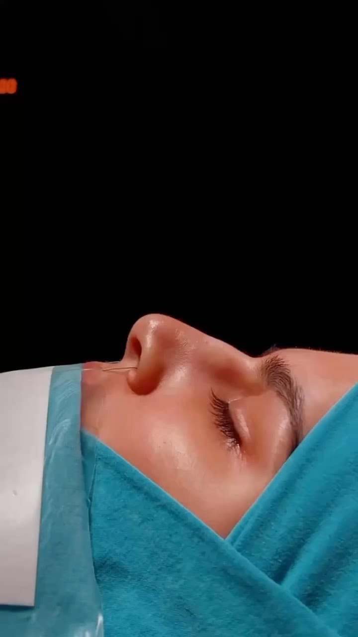 Post 1 by palmera clinic on Instagram (video)