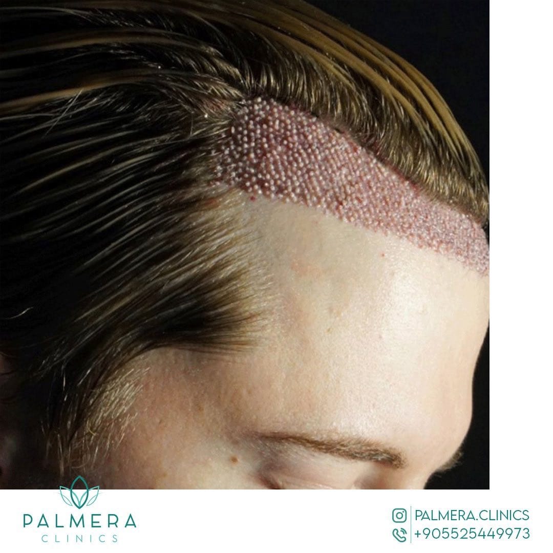 Post 4 by palmera clinic on Instagram (image)