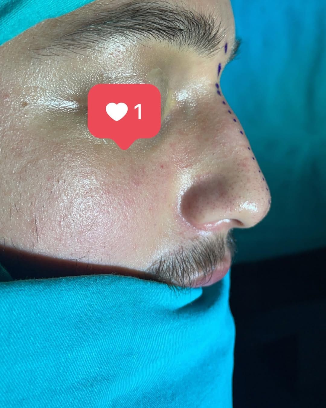 Post 3 by Bi Hospital Esthetic Center on Instagram (carousel)