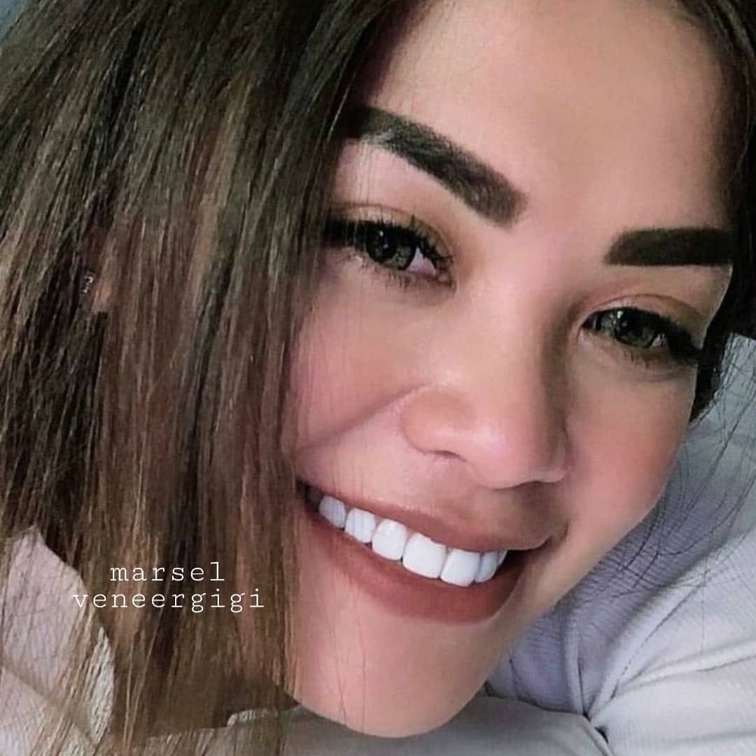 Post 10 by MARSEL VENEER GIGI on Instagram (image)