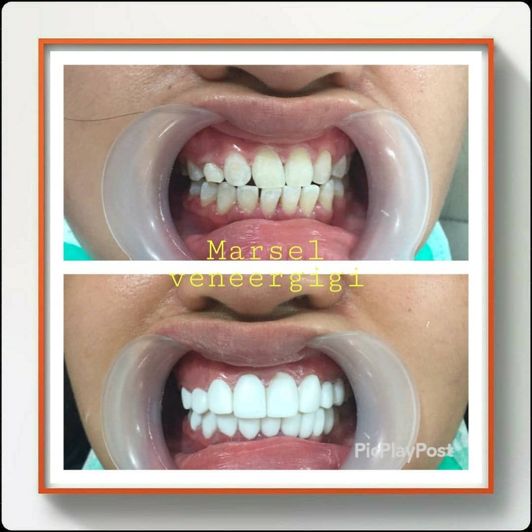 Post 6 by MARSEL VENEER GIGI on Instagram (image)