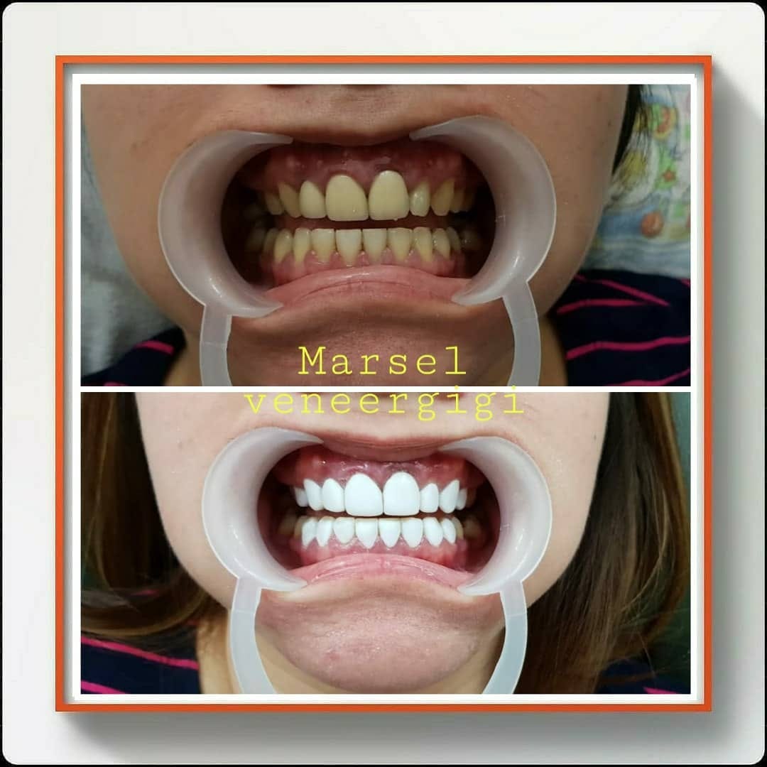 Post 5 by MARSEL VENEER GIGI on Instagram (image)