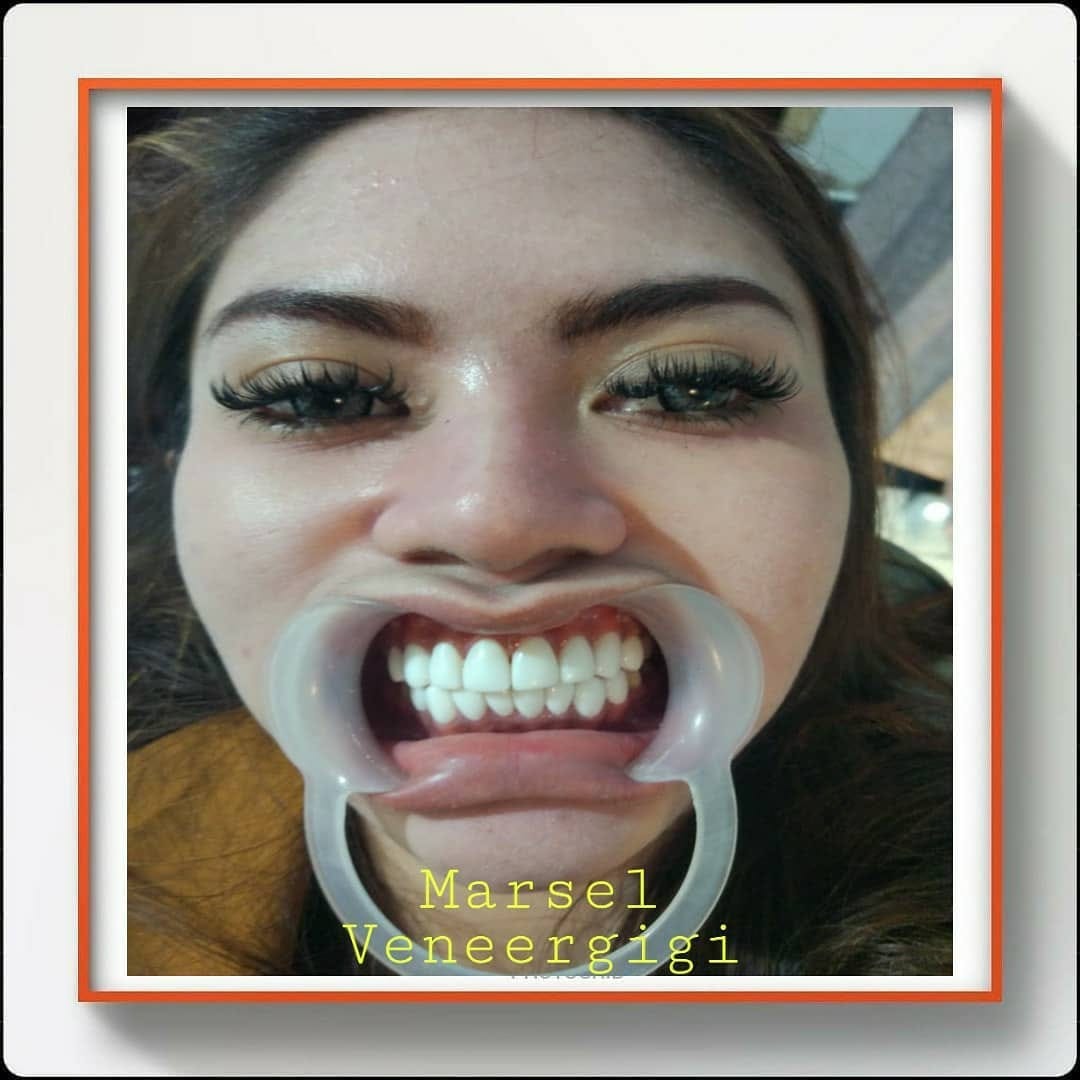 Post 7 by MARSEL VENEER GIGI on Instagram (image)