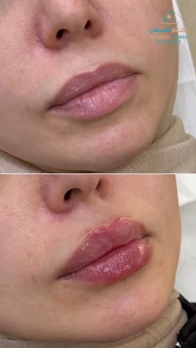 Post 4 by Spanish Center Derma on Instagram (video)