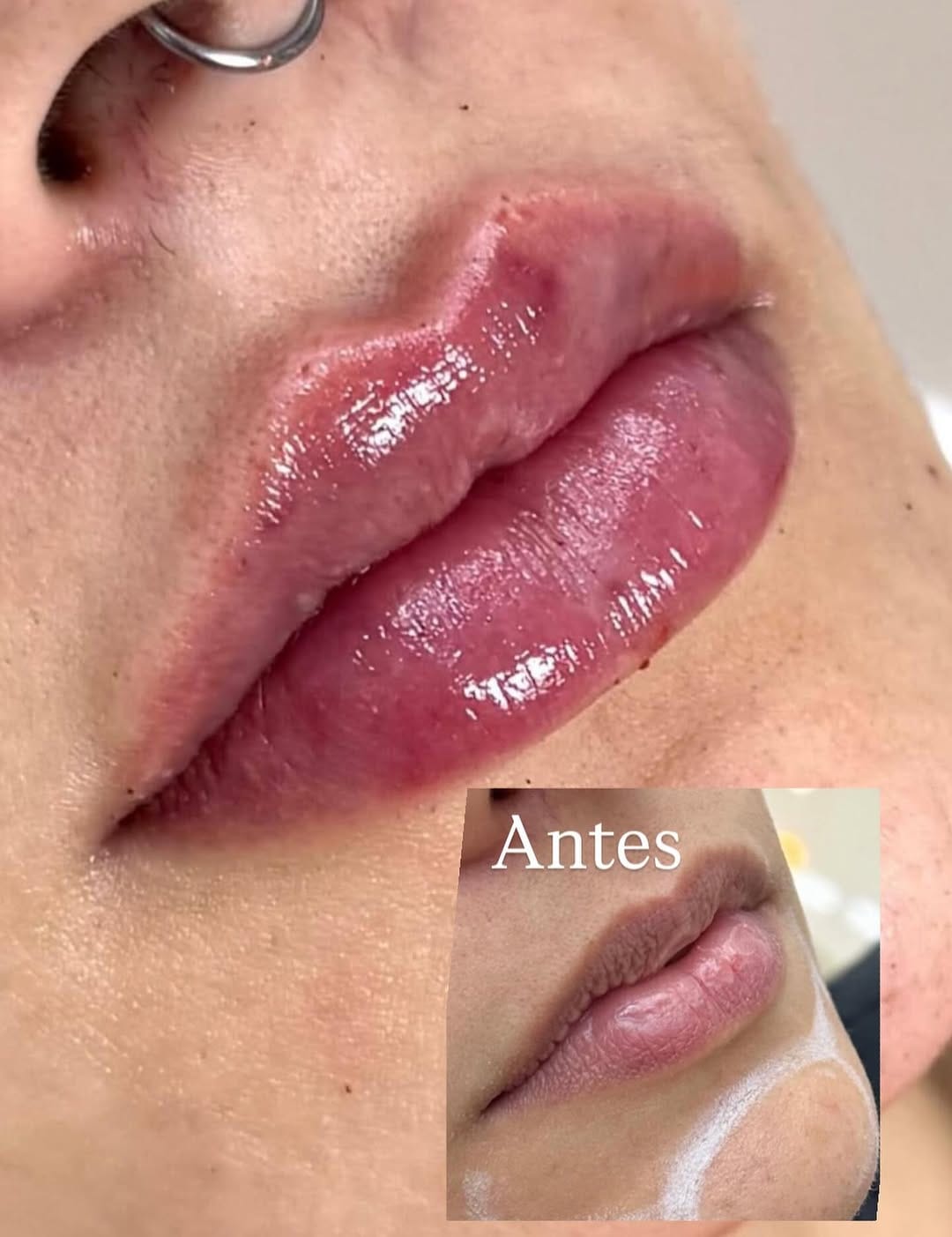 Post 5 by Marta Folgado| Harmonização on Instagram (image)