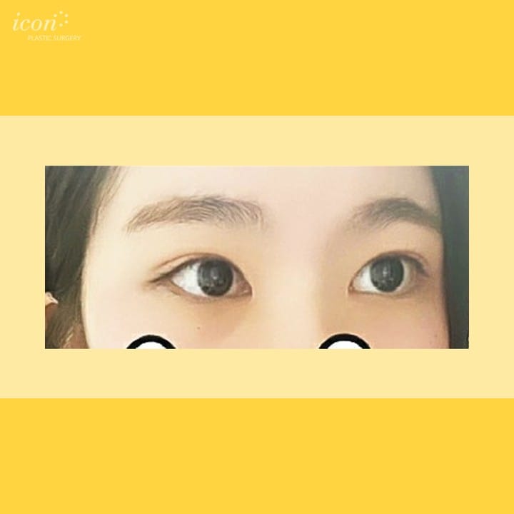 Post 8 by 아이콘성형외과 on Instagram (image)