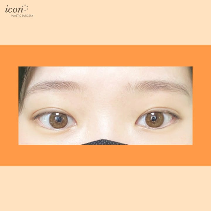 Post 2 by 아이콘성형외과 on Instagram (image)