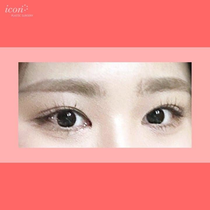 Post 10 by 아이콘성형외과 on Instagram (image)