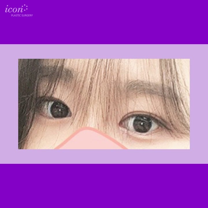 Post 4 by 아이콘성형외과 on Instagram (image)