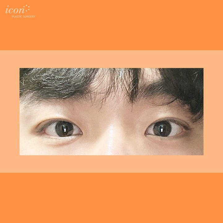 Post 9 by 아이콘성형외과 on Instagram (image)