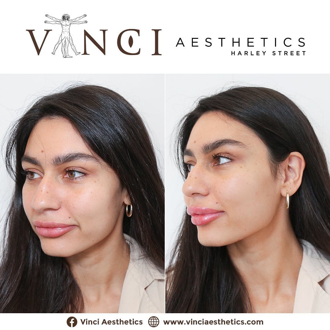 Post 1 by Vinci Aesthetics on Instagram (carousel)