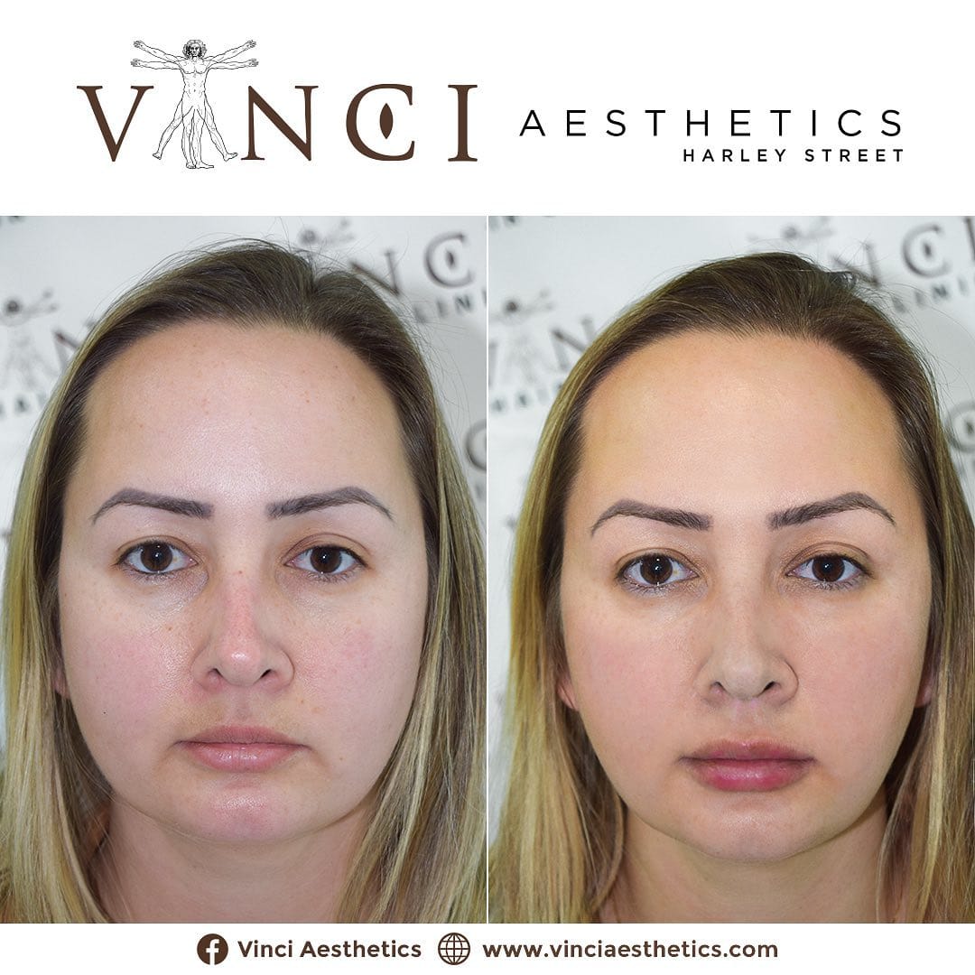 Post 2 by Vinci Aesthetics on Instagram (image)