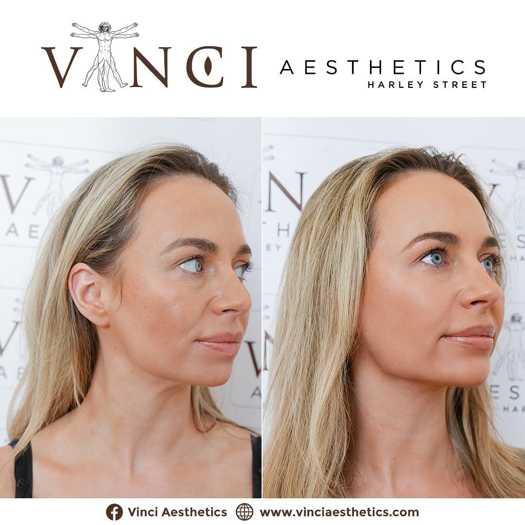 Post 8 by Vinci Aesthetics on Instagram (carousel)