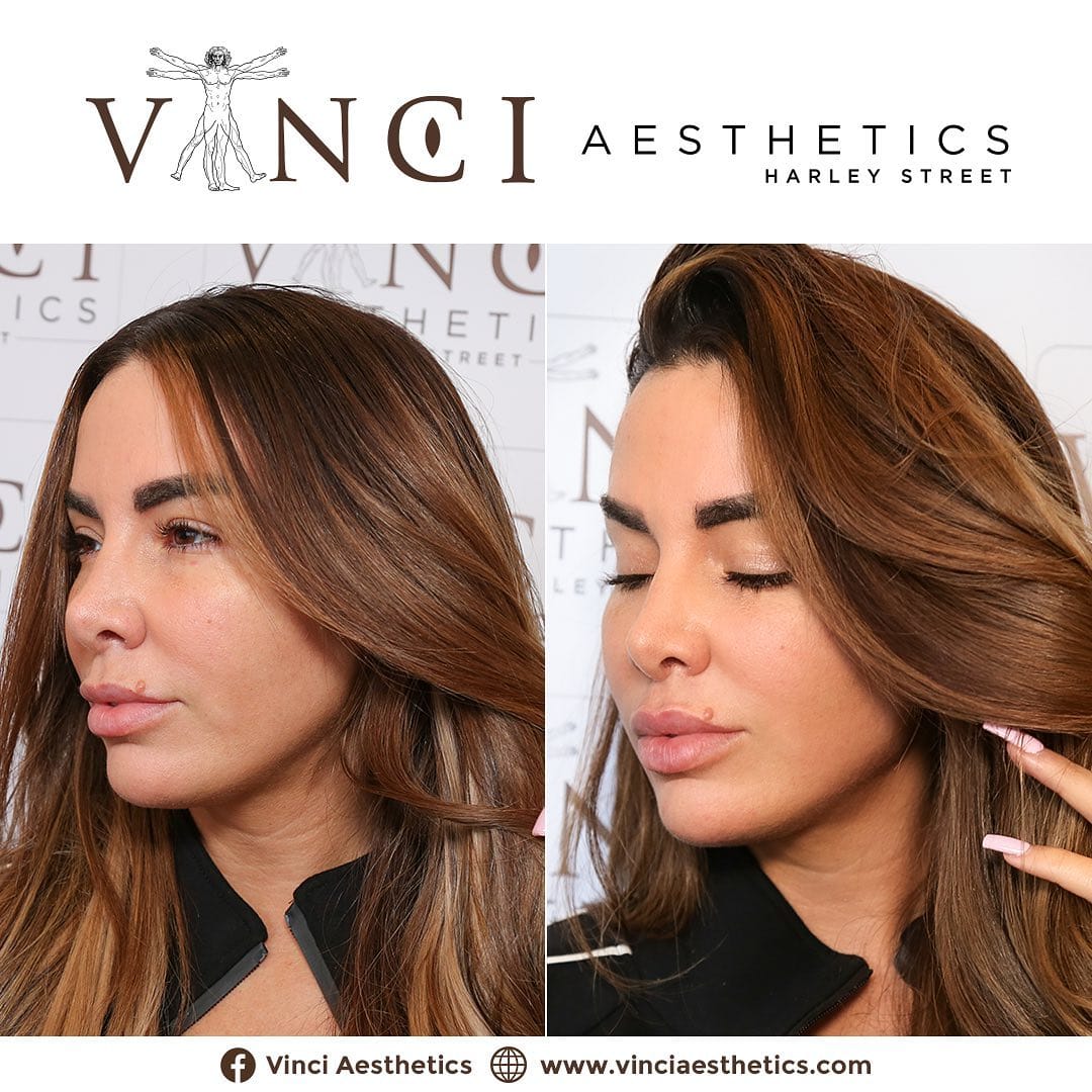 Post 10 by Vinci Aesthetics on Instagram (carousel)