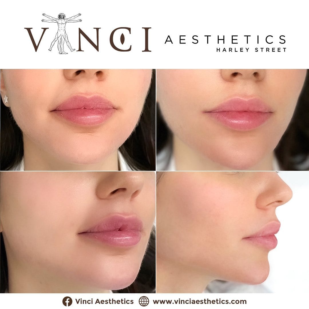 Post 4 by Vinci Aesthetics on Instagram (image)